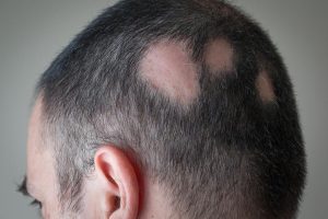 Alopecija