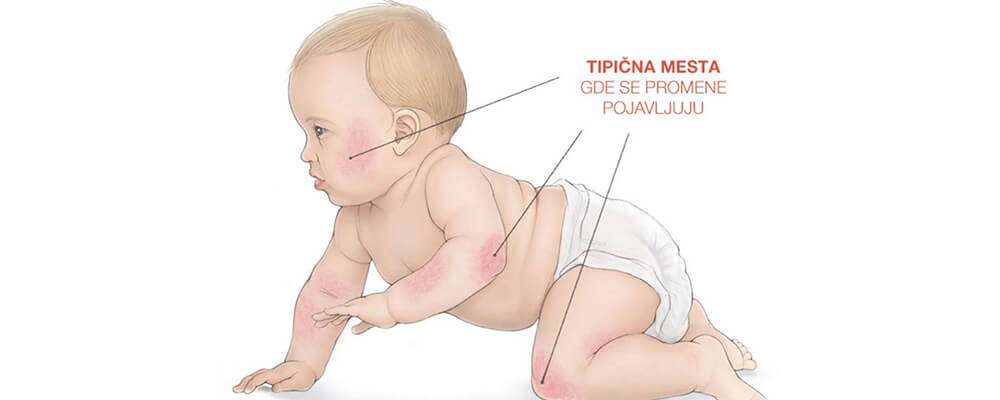 Atopijski dermatitis-ekcem